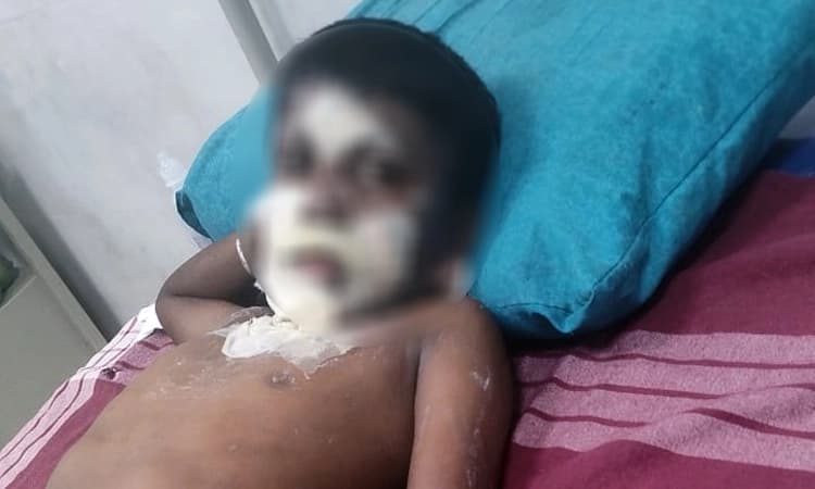 Ramanagara: ಪ್ರತಿಭಾ ಕಾರಂಜಿ ತಾಲೀಮು ವೇಳೆ ಪೆಟ್ರೋಲ್ ಬಿದ್ದು ವಿದ್ಯಾರ್ಥಿಗೆ ಸುಟ್ಟ ಗಾಯ