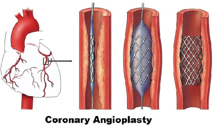 Coronary Angioplasty: ಕೊರೊನರಿ ಆಂಜಿಯೋಪ್ಲಾಸ್ಟಿಯ ಅನಂತರದ ಜೀವನಶೈಲಿ