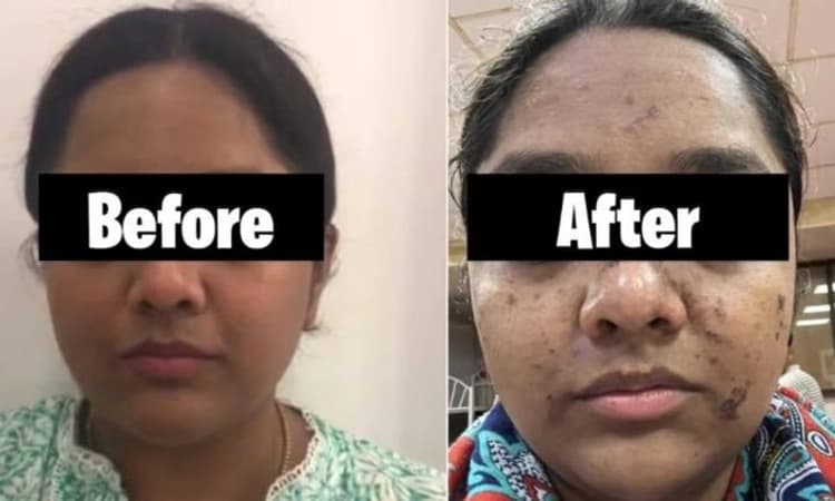 Hydrafacial: 17,500 ಕೊಟ್ಟು ಫೇಷಿಯಲ್ ಮಾಡಿದ ಮಹಿಳೆಯ ಮುಖ ಹೇಗಾಗಿದೆ ನೋಡಿ