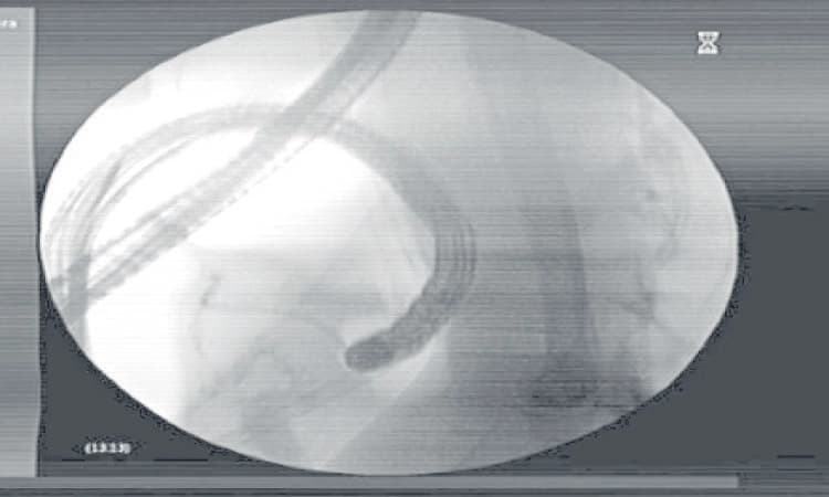 ಮಣಿಪಾಲ KMC ಆಸ್ಪತ್ರೆ: ಮೊದಲ ಬಾರಿಗೆ ನವೀನ ಎಂಡೋಸ್ಕೋಪಿ ಚಿಕಿತ್ಸೆ