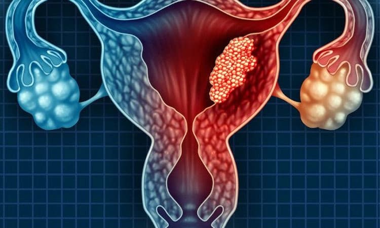 Cervical cancer: ಗರ್ಭಕಂಠದ ಕ್ಯಾನ್ಸರ್‌ ಉಂಟಾಗುವುದನ್ನು ತಡೆಯಲು ಸಲಹೆಗಳು