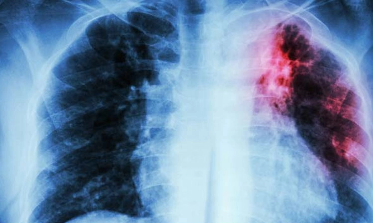 TB patients: ಕ್ಷಯ ರೋಗಿಗಳಿಗಿಲ್ಲ ಮಾಸಿಕ 500 ಸಹಾಯಧನ