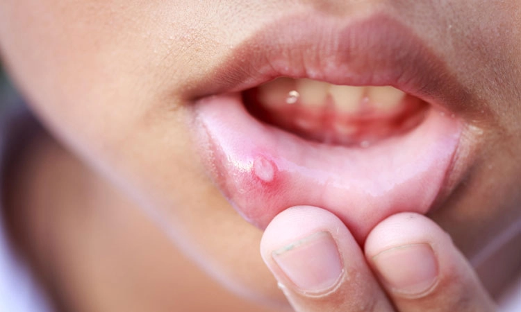 Mouth Ulcers: ಬಾಯಿಯ ಹುಣ್ಣುಗಳು ಮತು ನಿರ್ವಹಣೆ