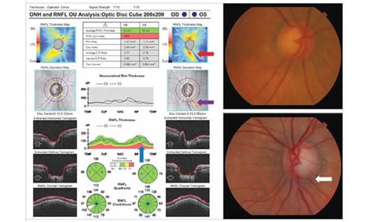 Eye Health; ನೇತ್ರ ಒತ್ತಡದಿಂದ ದೃಷ್ಟಿನರಗಳಿಗೆ ಹಾನಿ;ನಿಯಮಿತ ನೇತ್ರ ತಪಾಸಣೆಯಿಂದ ತಡೆಗಟ್ಟಿ