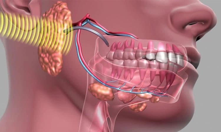 ಬಾಯಿಯ ಕ್ಯಾನ್ಸರ್‌ ಮತ್ತು ರೇಡಿಯೇಶನ್‌ ಥೆರಪಿ
