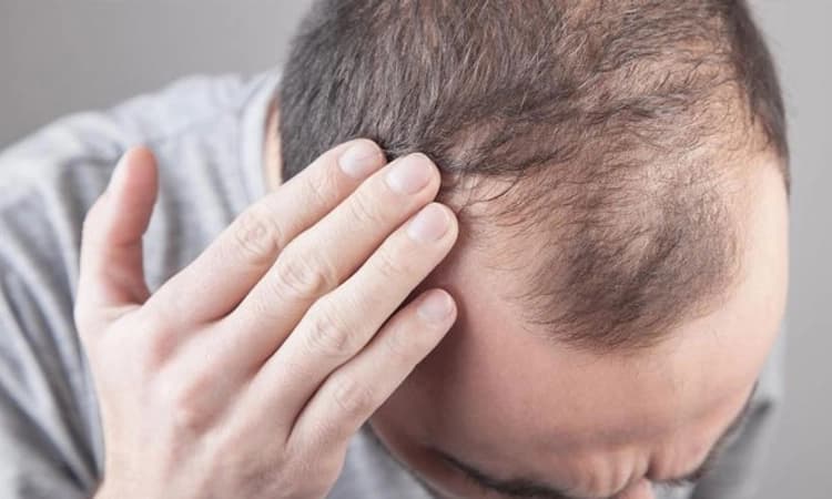 Hair Loss: ಕೂದಲು ಉದುರುವಿಕೆಯ ಸಮಸ್ಯೆಗೆ ಕಾರಣಗಳೇನು? ಮನೆ ಪರಿಹಾರ ಏನು? ಇಲ್ಲಿದೆ ಉತ್ತರ