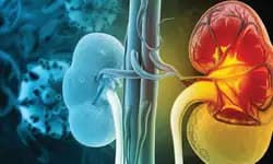 Lupus Nephritis: ಲೂಪಸ್‌ ನೆಫ್ರೈಟಿಸ್‌ ರೋಗಿಗಳಿಗೆ ಒಂದು ಮಾರ್ಗದರ್ಶಿ