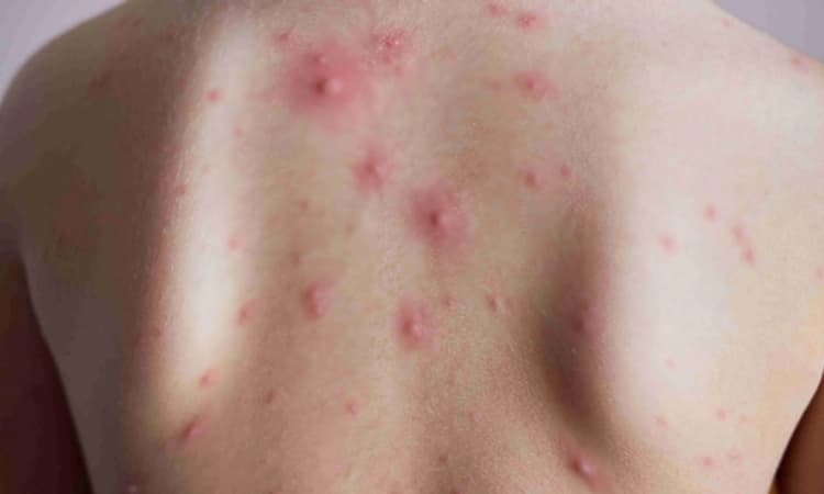 ಚಿಕನ್‌ ಪಾಕ್ಸ್ ‌ಸ್ವಚ್ಛತೆ ಪಾಲಿಸಿ, ಪಥ್ಯ ಅನುಸರಿಸಿ