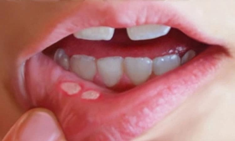 ಬೇಸಿಗೆಯಲ್ಲಿ ಕಾಡುವ ಬಾಯಿ ಹುಣ್ಣಿಗೆ ಇಲ್ಲಿದೆ ನೋಡಿ ಮನೆ ಮದ್ದು  