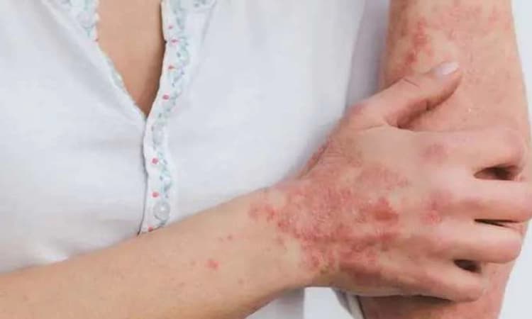 ವಿಶ್ವ ಸೋರಿಯಾಸಿಸ್ ದಿನ 2022; ಸೋರಿಯಾಸಿಸ್‌ ಗುರುತಿಸುವುದು ಹೇಗೆ?