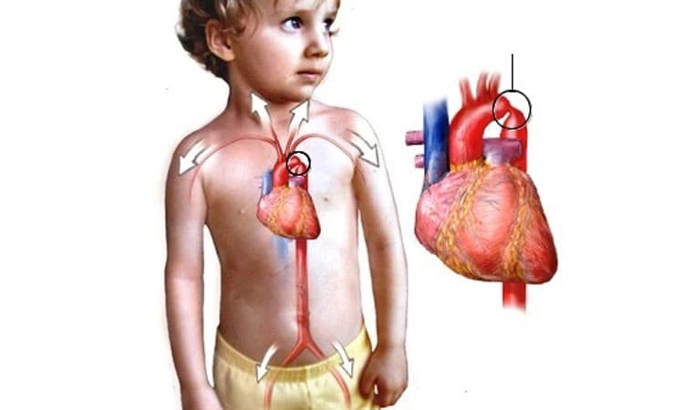 ಮಕ್ಕಳಲ್ಲಿ ಕಂಡುಬರುವ ಹೃದಯದ ಕಾಯಿಲೆಗಳು