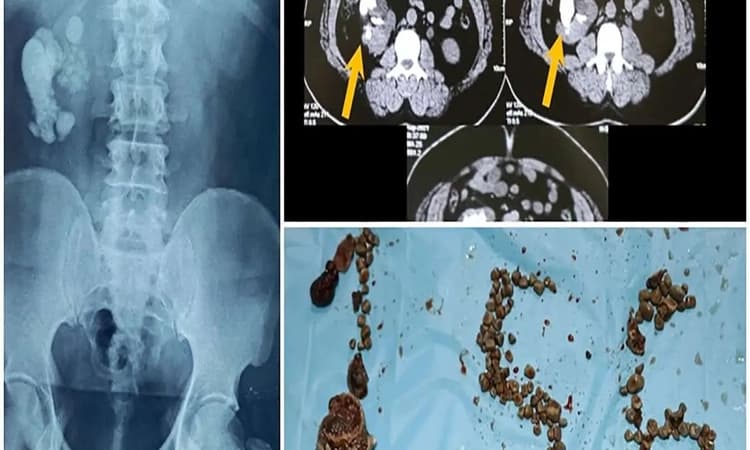 Doctors remove record 156 kidney stones from 50-yo Hubli patient by keyhole opening