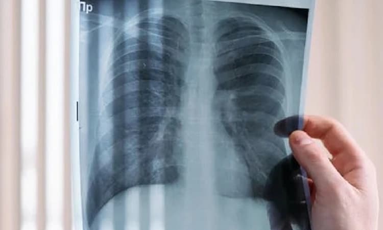 Burden of lung diseases in India likely much higher than Lancet study’s projection: Doctors