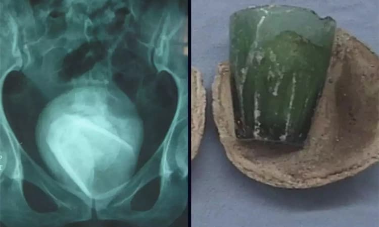 Woman’s ‘UTI’ turned out to be glass tumbler stuck in bladder for 4 years