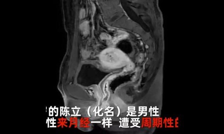 Chinese man with ‘urinary issues’ is intersex, with ovaries, uterus and has been menstruating for 20 years