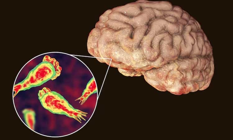 Kerala Girl: ಮೆದುಳು ತಿನ್ನುವ ಅಮೀಬಾ ಸೋಂಕಿಗೆ ಕೇರಳದ 9 ವರ್ಷದ ಬಾಲಕಿ ಮೃ*ತ್ಯು