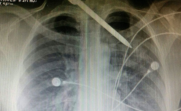 ice-pick-x-ray-pti.jpg