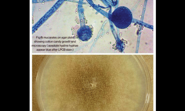 Covid-19 and mucormycosis