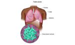 3–Pulmonary-Tuberculosis