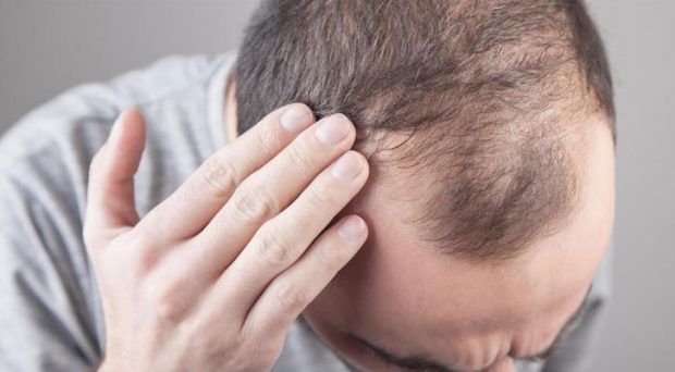 Hair Loss: Causes and Home Remedies