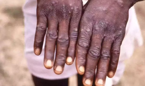 Another suspected monkeypox case detected in Kerala: 2nd case in the country